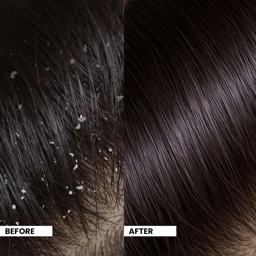 Botanic Balance Anti-Dandruff Shampoo – Natural Dandruff Fighter with Sitafal Extract | 100 ml | 200 ml