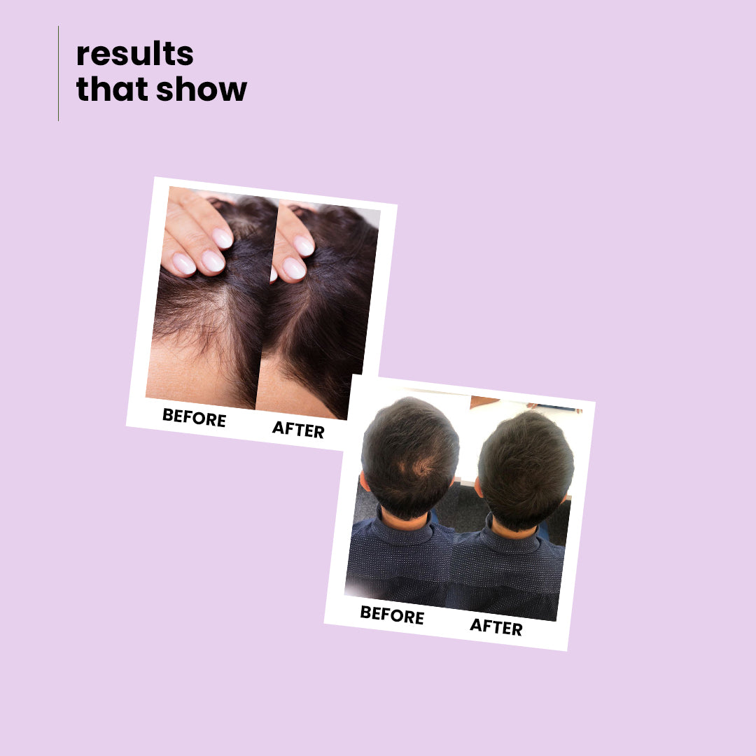 Onion & Rosemary Growth Boost Shampoo for Strong, Shiny Hair | 200 ml