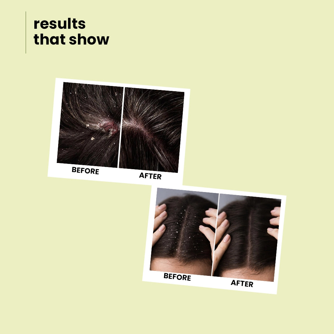 Botanic Balance Anti-Dandruff Shampoo – Natural Dandruff Fighter with Sitafal Extract | 100 ml | 200 ml