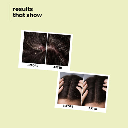 Botanic Balance Anti-Dandruff Shampoo – Natural Dandruff Fighter with Sitafal Extract | 100 ml | 200 ml